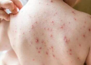 …तर मुंबईतील वाढत्या गोवरच्या साथीबाबतचा अहवाल थेट दिल्लीत.?