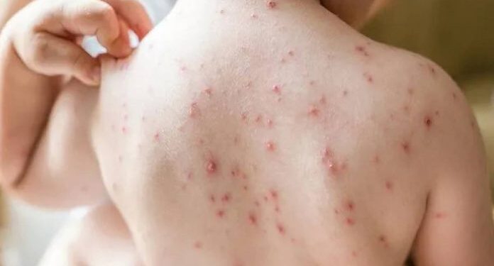 …तर मुंबईतील वाढत्या गोवरच्या साथीबाबतचा अहवाल थेट दिल्लीत.?