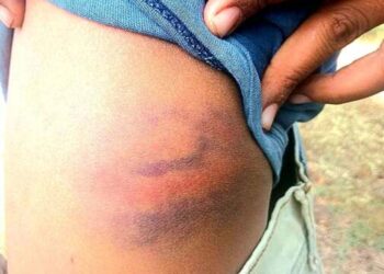 तासगावात अल्पवयीन विद्यार्थ्यांना अमानुष मारहाण