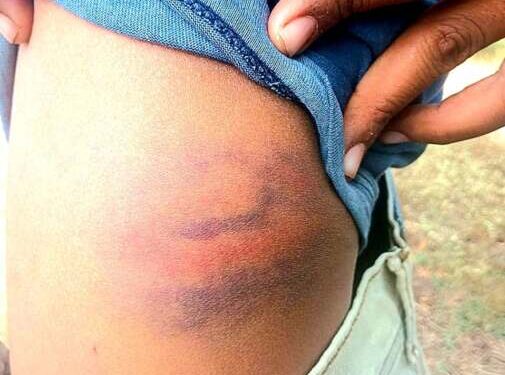 तासगावात अल्पवयीन विद्यार्थ्यांना अमानुष मारहाण