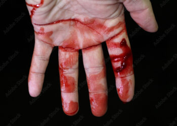 कुपवाड ब्रेकिंग |एमआयडीसीत हाताची चार बोटं तुटली, गोपीकिसन सारडा मिल’ला न्यायालयाचा दणका, कामगाराला मिळाला न्याय..!