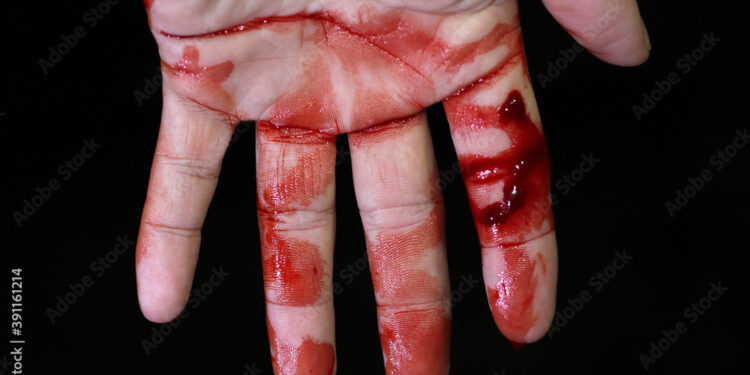 कुपवाड ब्रेकिंग |एमआयडीसीत हाताची चार बोटं तुटली, गोपीकिसन सारडा मिल’ला न्यायालयाचा दणका, कामगाराला मिळाला न्याय..!